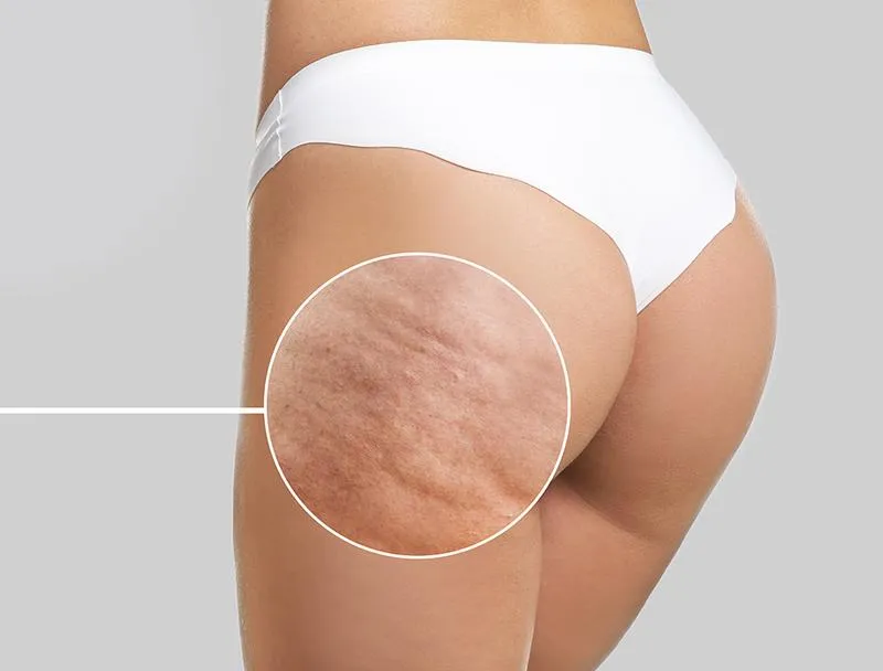 Bieganie czy rower na cellulit – co wybrać dla lepszej sylwetki?