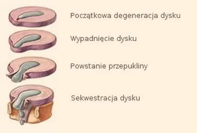 Czy z przepukliną kręgosłupa warto biegać? Oto, co powinieneś wiedzieć