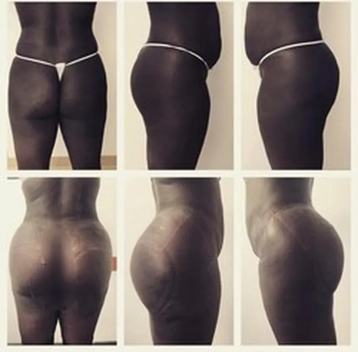 Bieganie a ujędrnienie pośladków