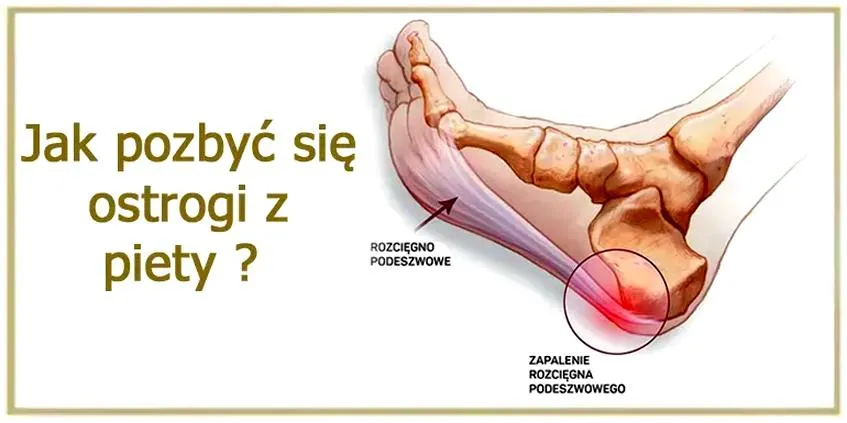Bieganie z ostrogą piętową
