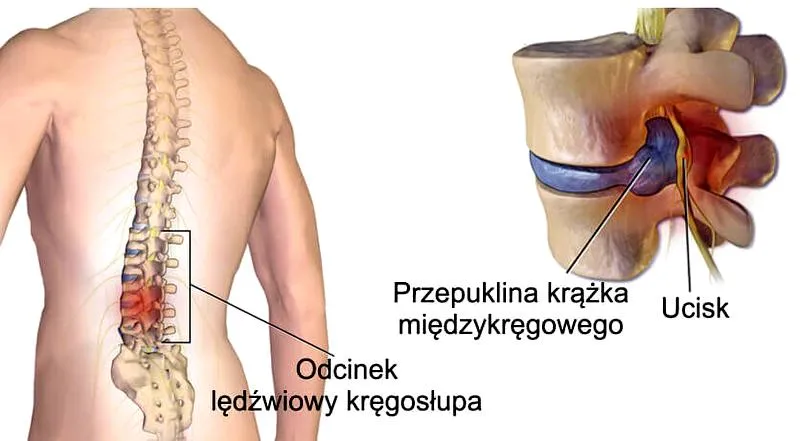 Bieganie z przepukliną