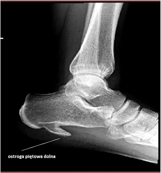 Ćwiczenia na ostrogę piętową