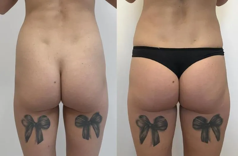 Kształt pośladków a genetyka