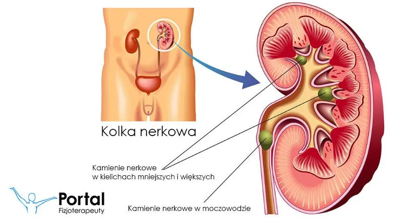Rogrzewka w profilaktyce kolki