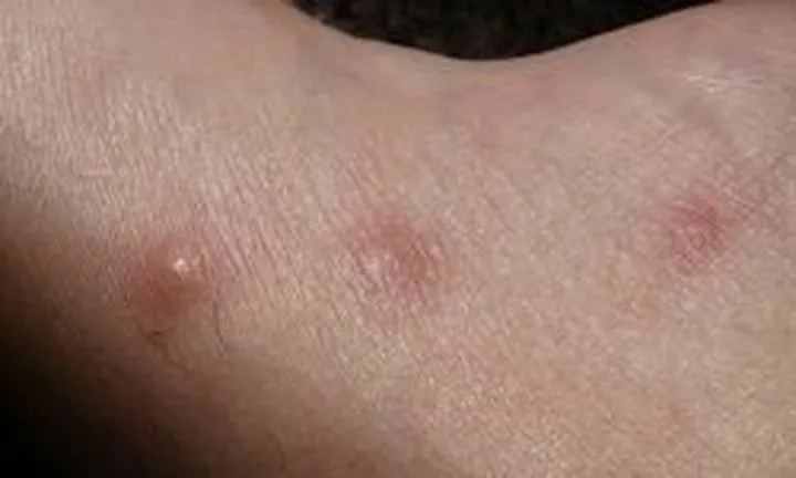 Swędzenie skóry podczas biegania